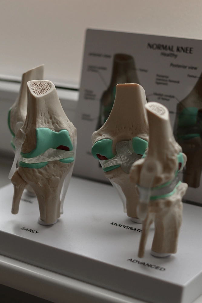 LPZ-Hübner - Physiotherapie und Lymphdrainage - Ein anatomisches Modell, das den Verlauf einer Kniearthrose in vier Stadien zeigt: gesund, früh, mittel und fortgeschritten.